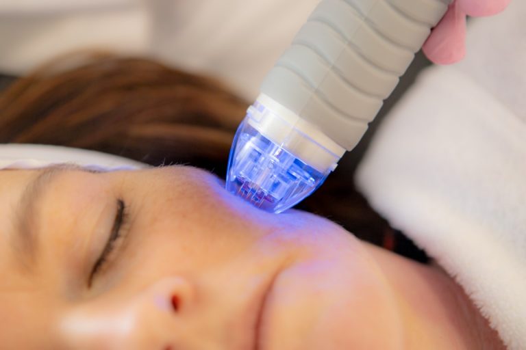 vivace-microneedling-rf-skin-s-thetic